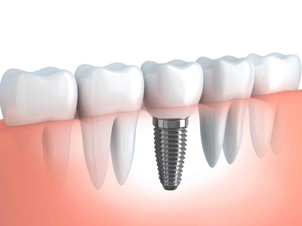 Single Tooth Dental Implant Procedure & Benefits vs. Traditional Bridges