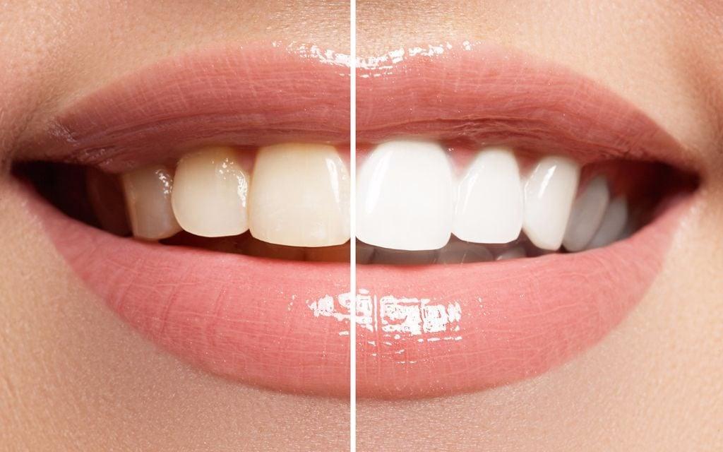 How Much Does Teeth Whitening Cost at the Dentist?