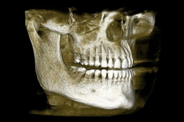 Immediate Dental Implant – Can You Really Get a Dental Implant Same Day as Extraction?