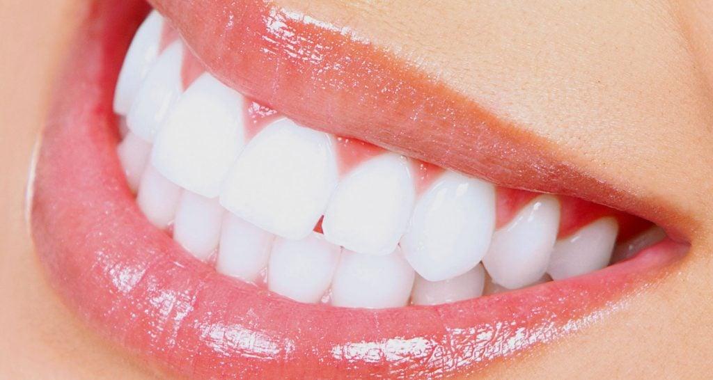 Porcelain Veneers