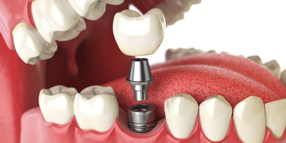 Types of Dental Implants
