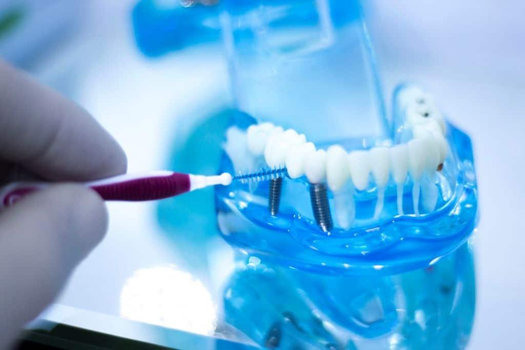 How to Clean Dental Implants: Dental Implant Care 101