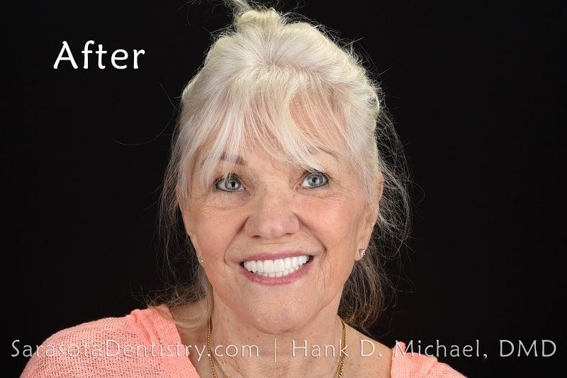 What is a Full Arch Dental Implant?