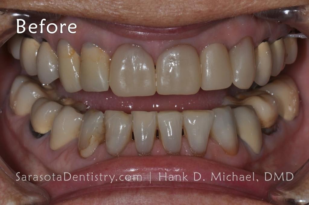 How to Fix Black Triangles in Teeth