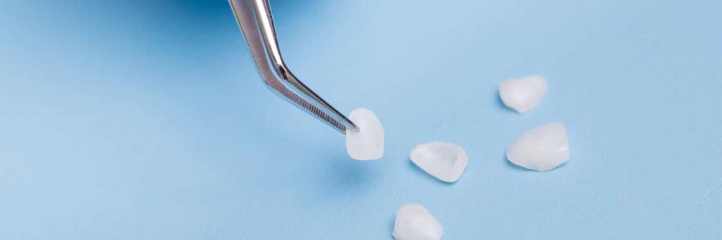 Snap On Veneers vs. Traditional Veneers