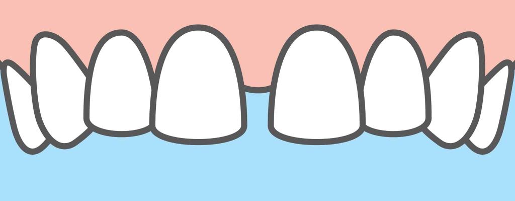 Diastema Causes and Treatment Options
