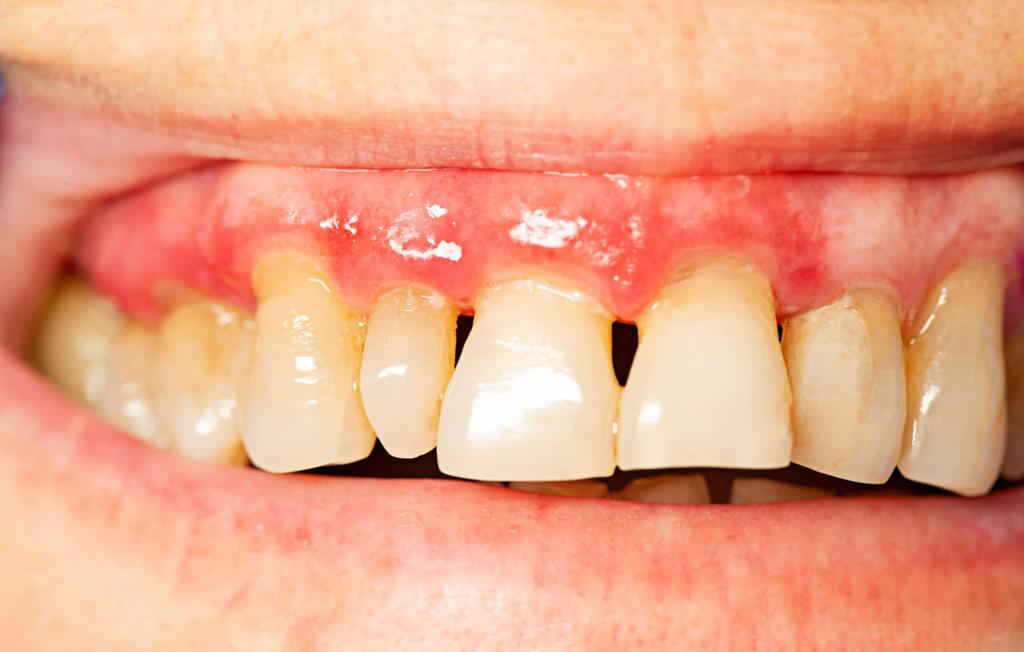 How Long Can You Keep Your Teeth with Periodontal Disease?