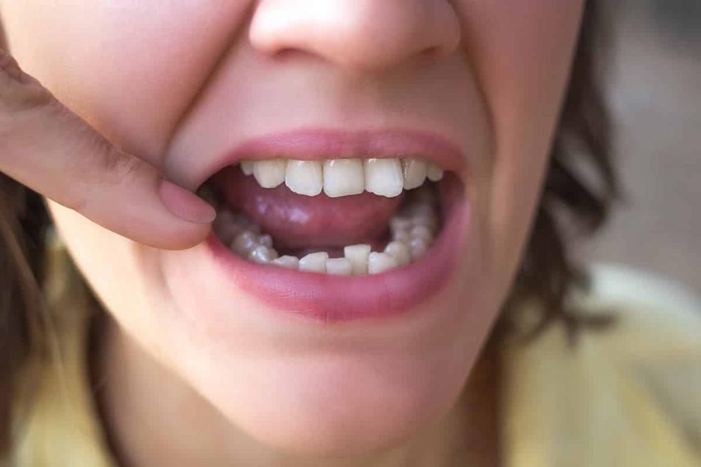 What Causes Crowded Teeth and How to Fix Them
