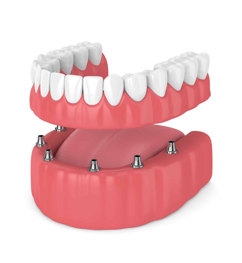 What Are Implant Overdentures, and are They Right for Me?