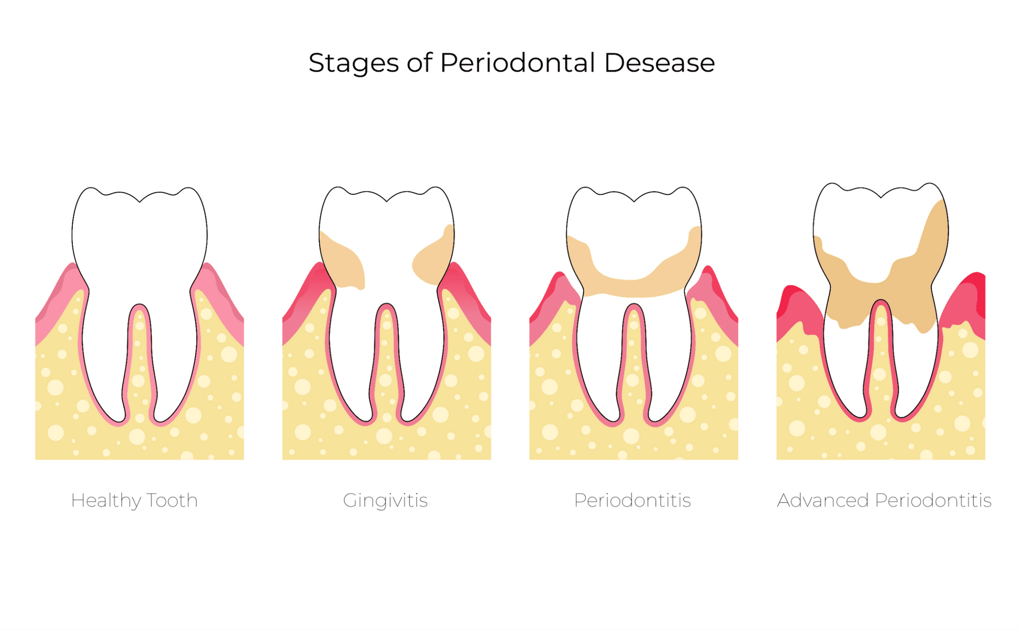Gingivitis vs. Periodontitis: What’s the Difference?