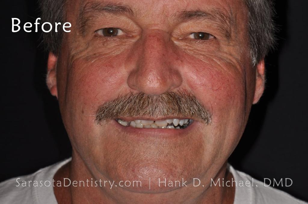 Smile Makeover 101: Porcelain Crowns and Dental Implants — view 2