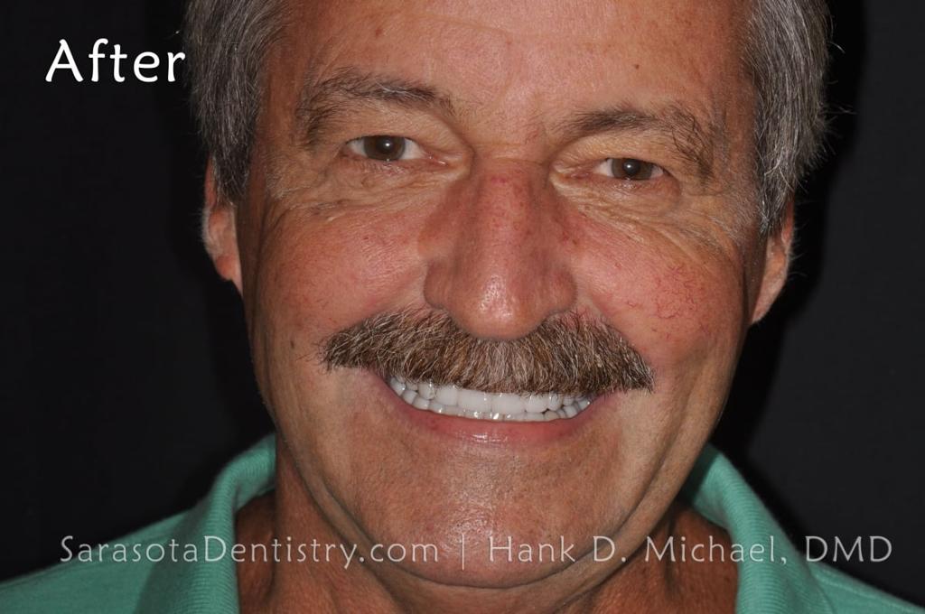 Smile Makeover 101: Porcelain Crowns and Dental Implants — view 1