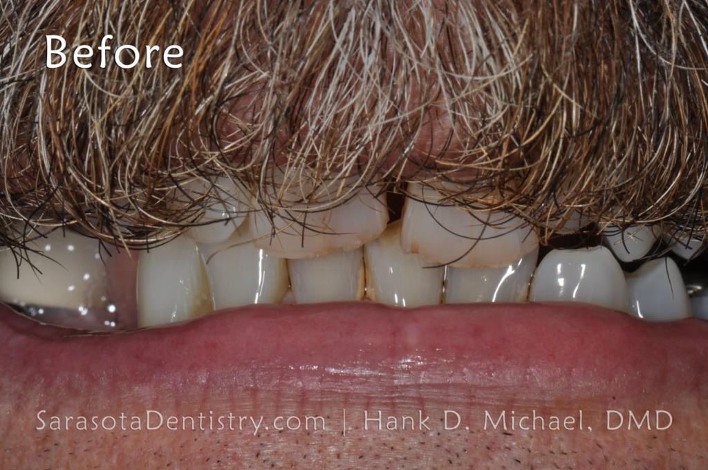 Smile Makeover 101: Porcelain Crowns and Dental Implants — view 3