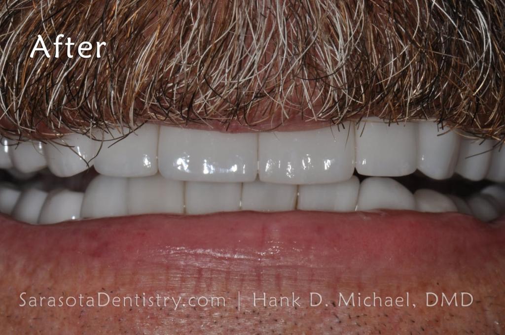 Smile Makeover 101: Porcelain Crowns and Dental Implants — view 4