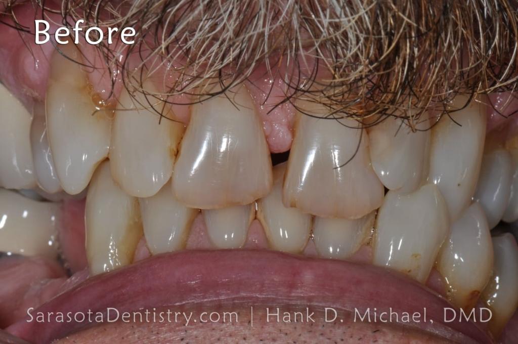 Smile Makeover 101: Porcelain Crowns and Dental Implants — view 5