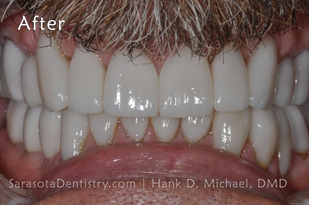 Smile Makeover 101: Porcelain Crowns and Dental Implants — view 6