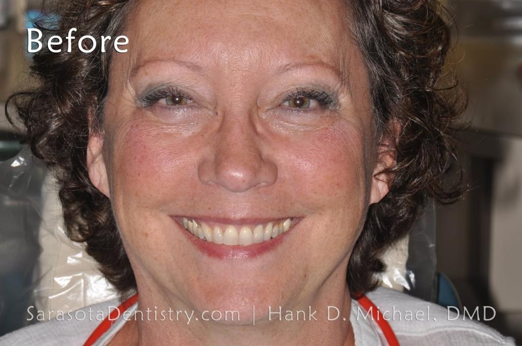 No-Prep Porcelain Veneers Smile Makeover 19 — view 2