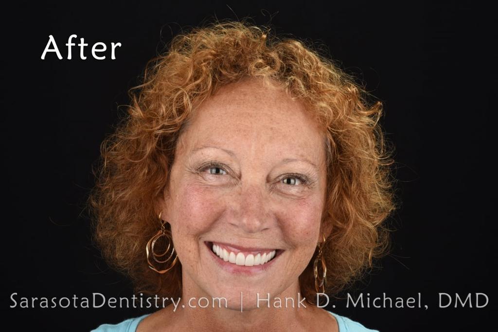 No-Prep Porcelain Veneers Smile Makeover 19 — view 1