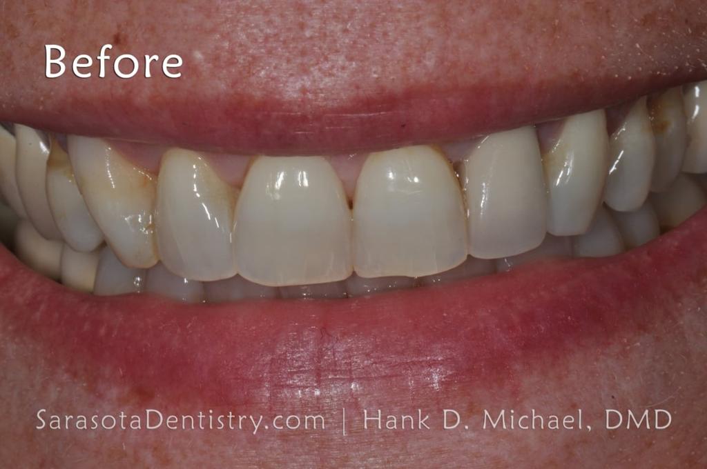 No-Prep Porcelain Veneers Smile Makeover 19 — view 3