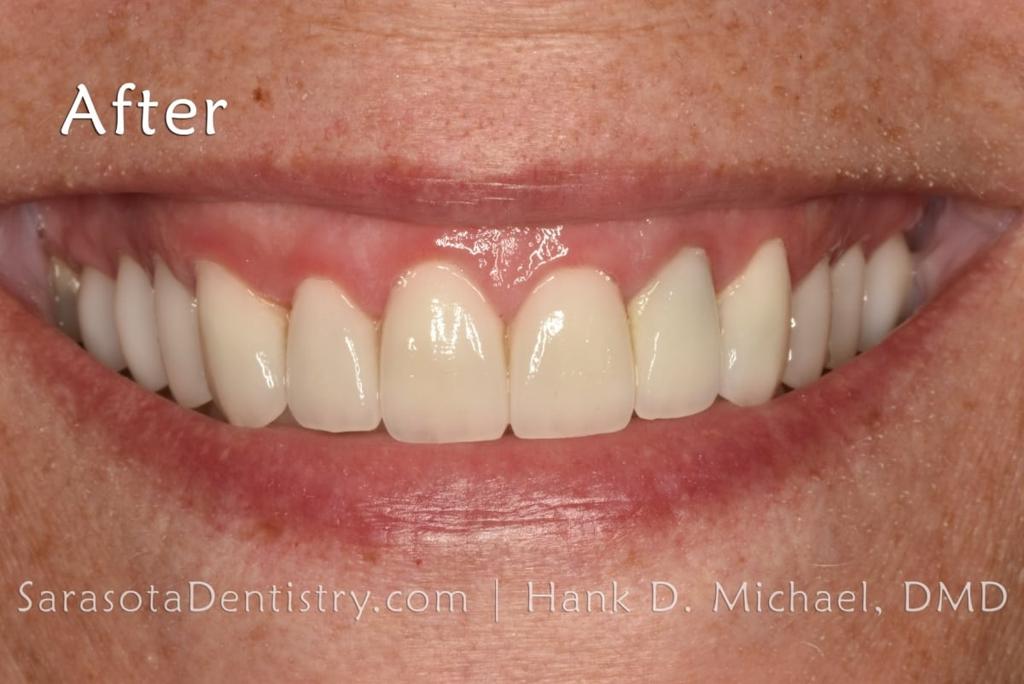 No-Prep Porcelain Veneers Smile Makeover 19 — view 4