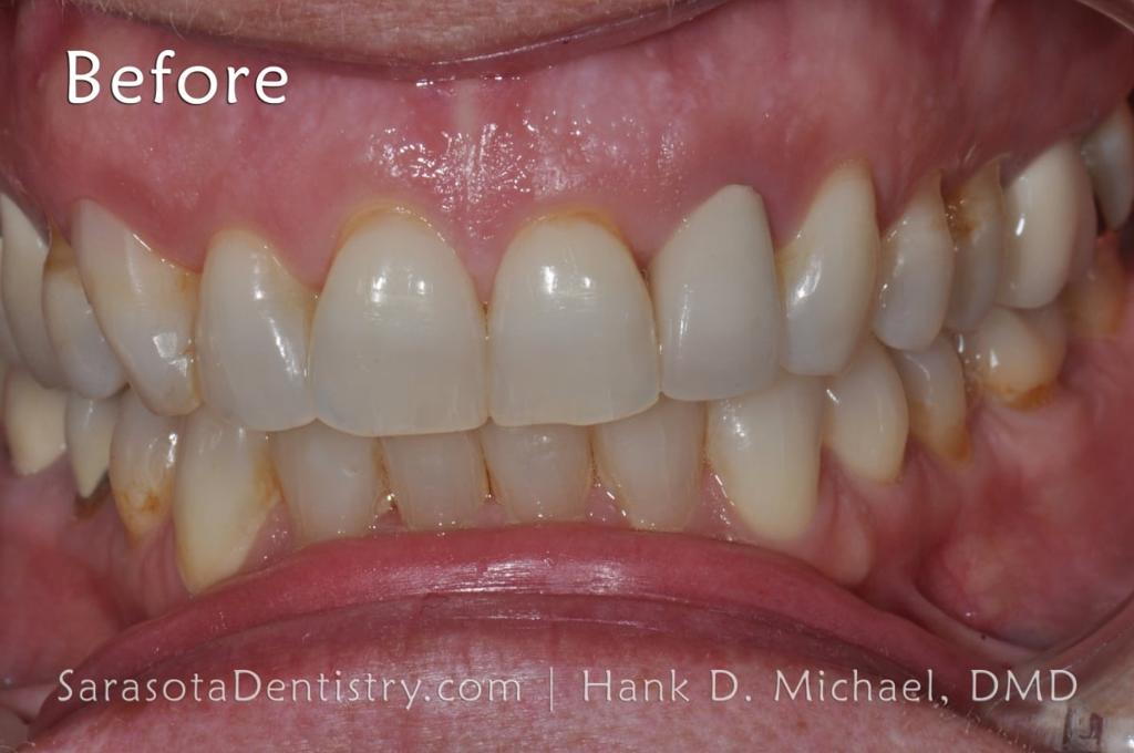 No-Prep Porcelain Veneers Smile Makeover 19 — view 5