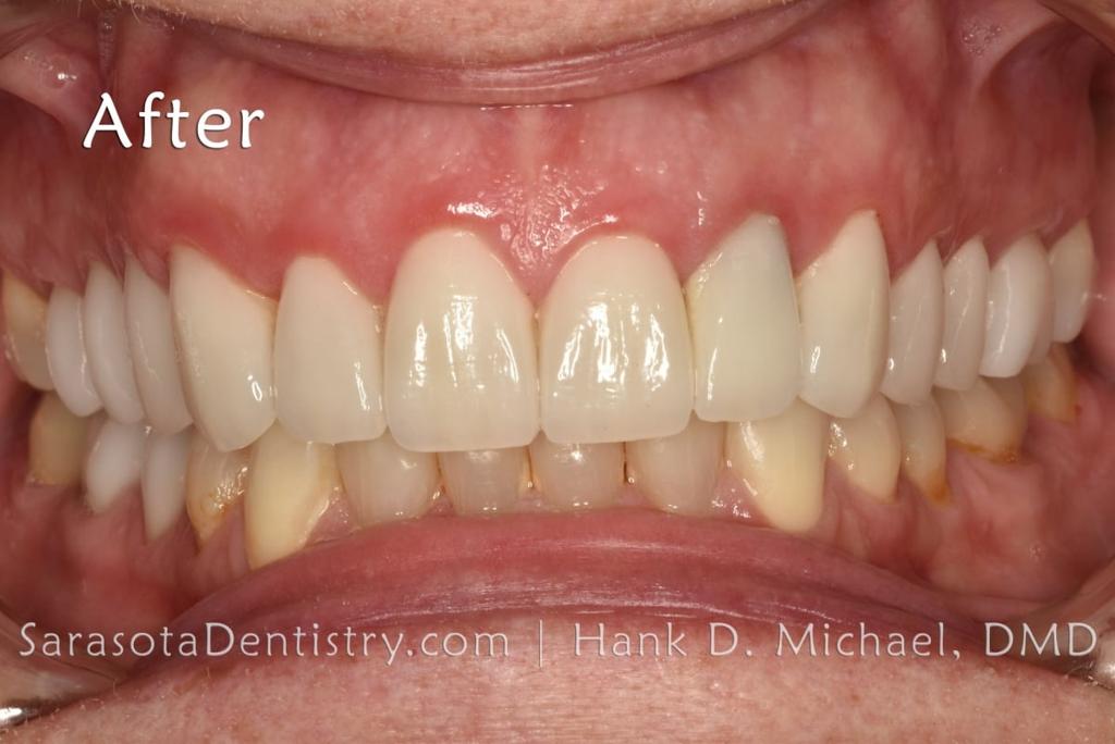 No-Prep Porcelain Veneers Smile Makeover 19 — view 6