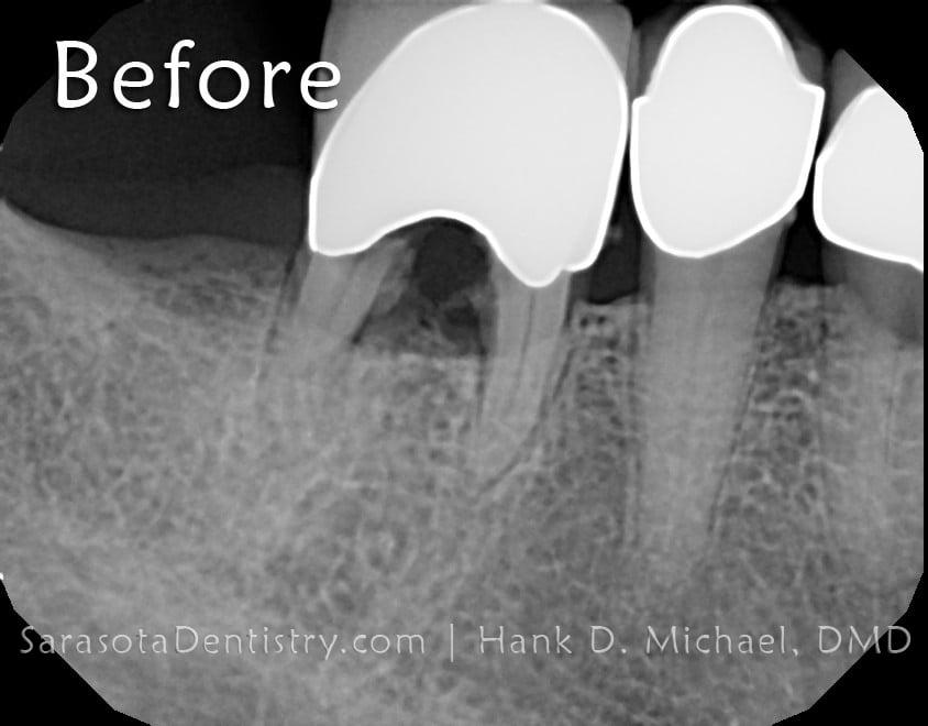 Dental Implant Smile Case 1
