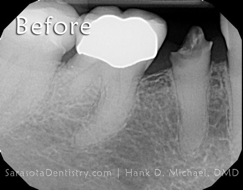 Dental Implant Smile Case #3