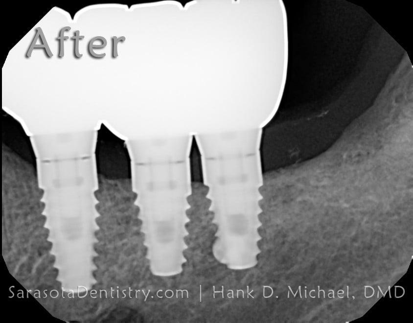 Dental Implants Case: Replacing Missing Back Teeth