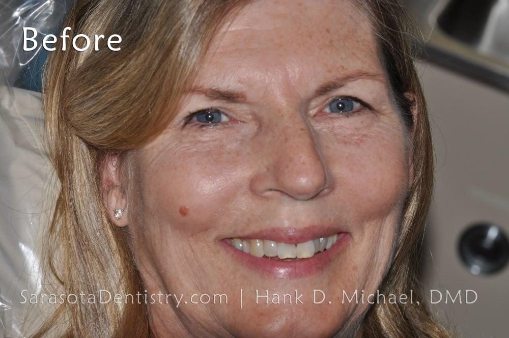 Porcelain Veneers Smile Makeover #13