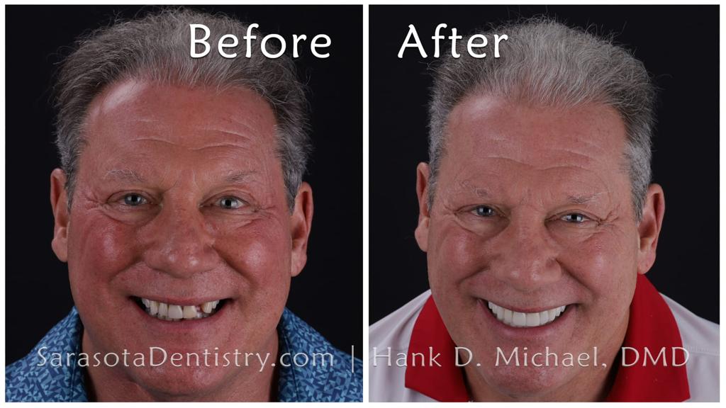 Dental implants and zirconia crowns — before and after