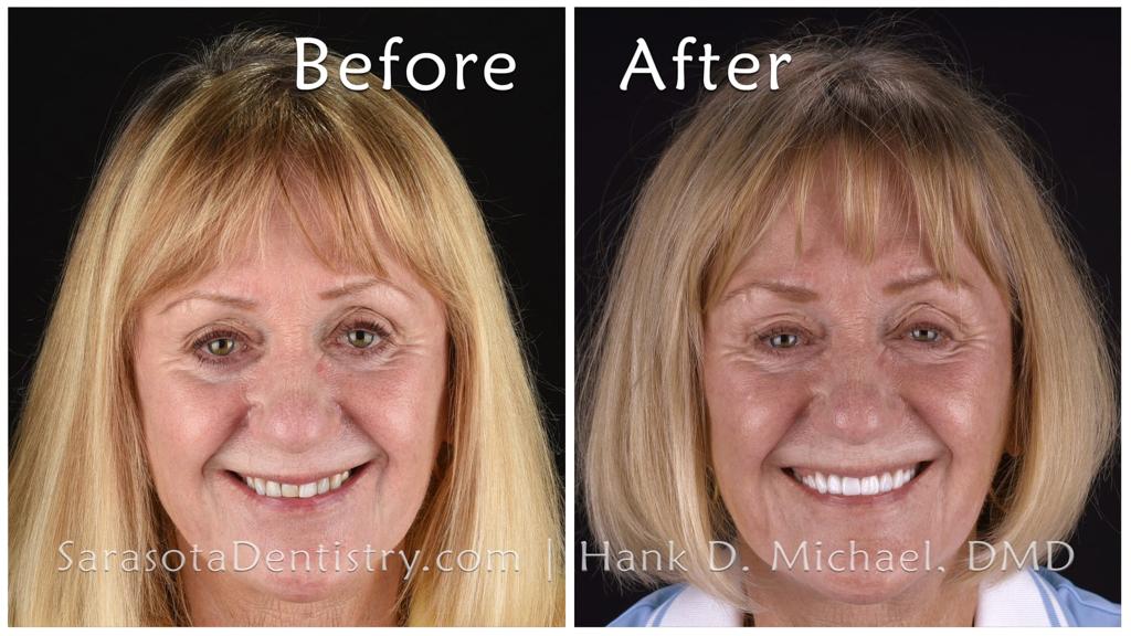 E.max same-day smile makeover — before and after