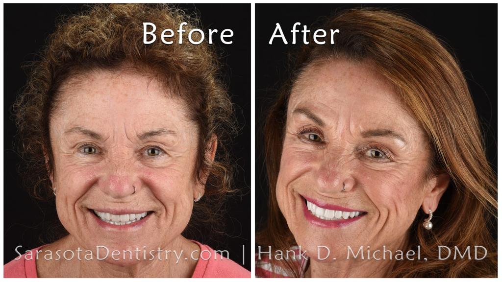 Full-mouth zirconia crowns smile makeover — before and after
