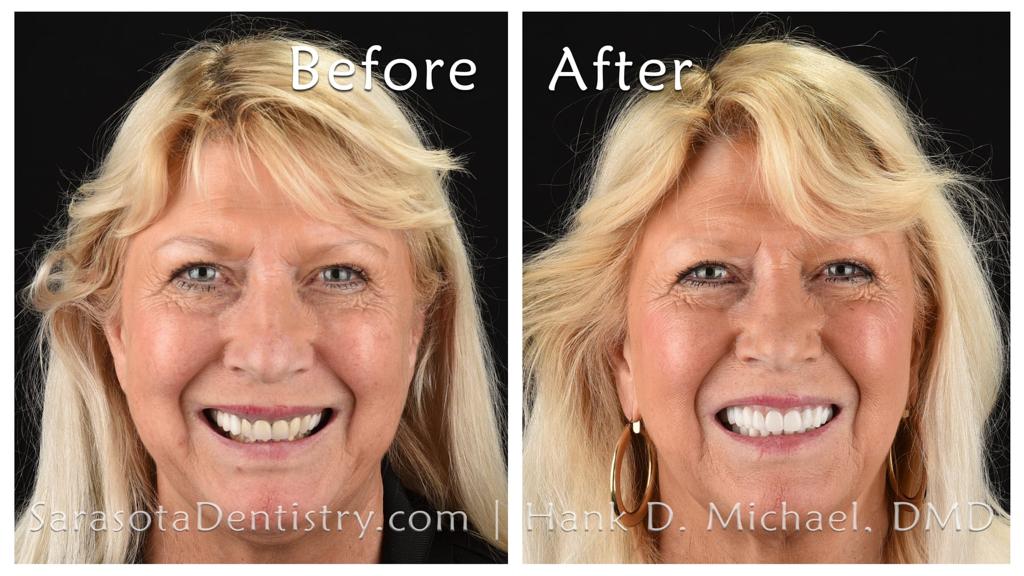 Smile makeover with dental implants — before and after
