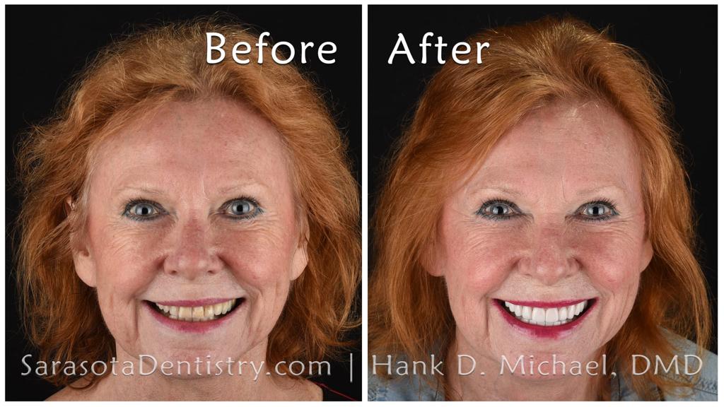Smile makeover with zirconia crowns — before and after