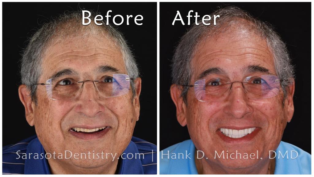 Smile reconstruction with dental implants — before and after