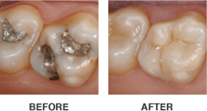 Same-Day Crowns