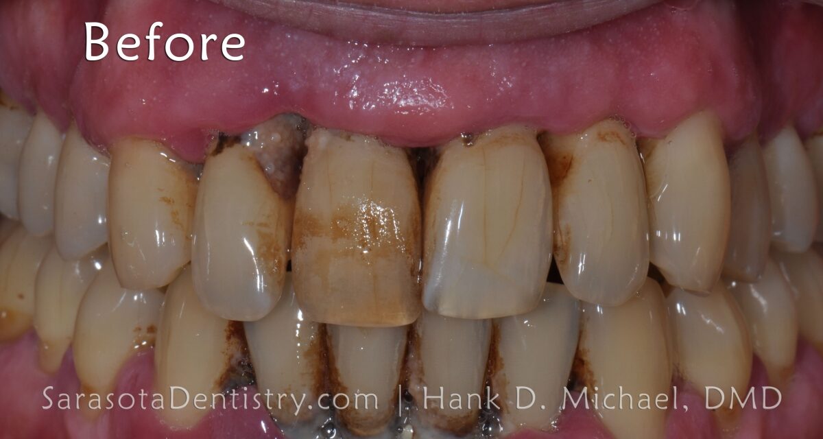 Does tartar Removal Damage Teeth?
