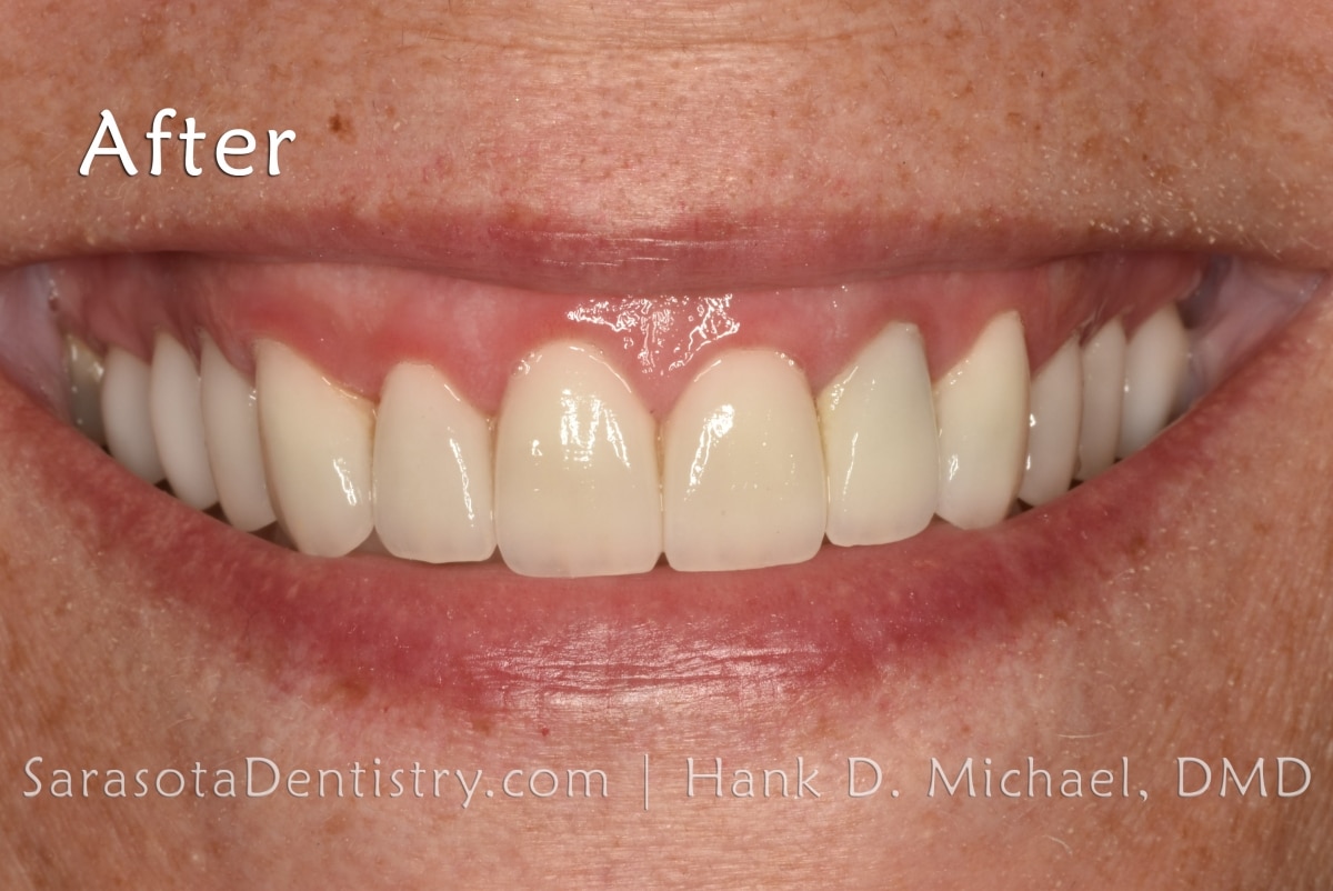 How Much Do Veneers Cost? Pros & Cons Sarasota Dentistry