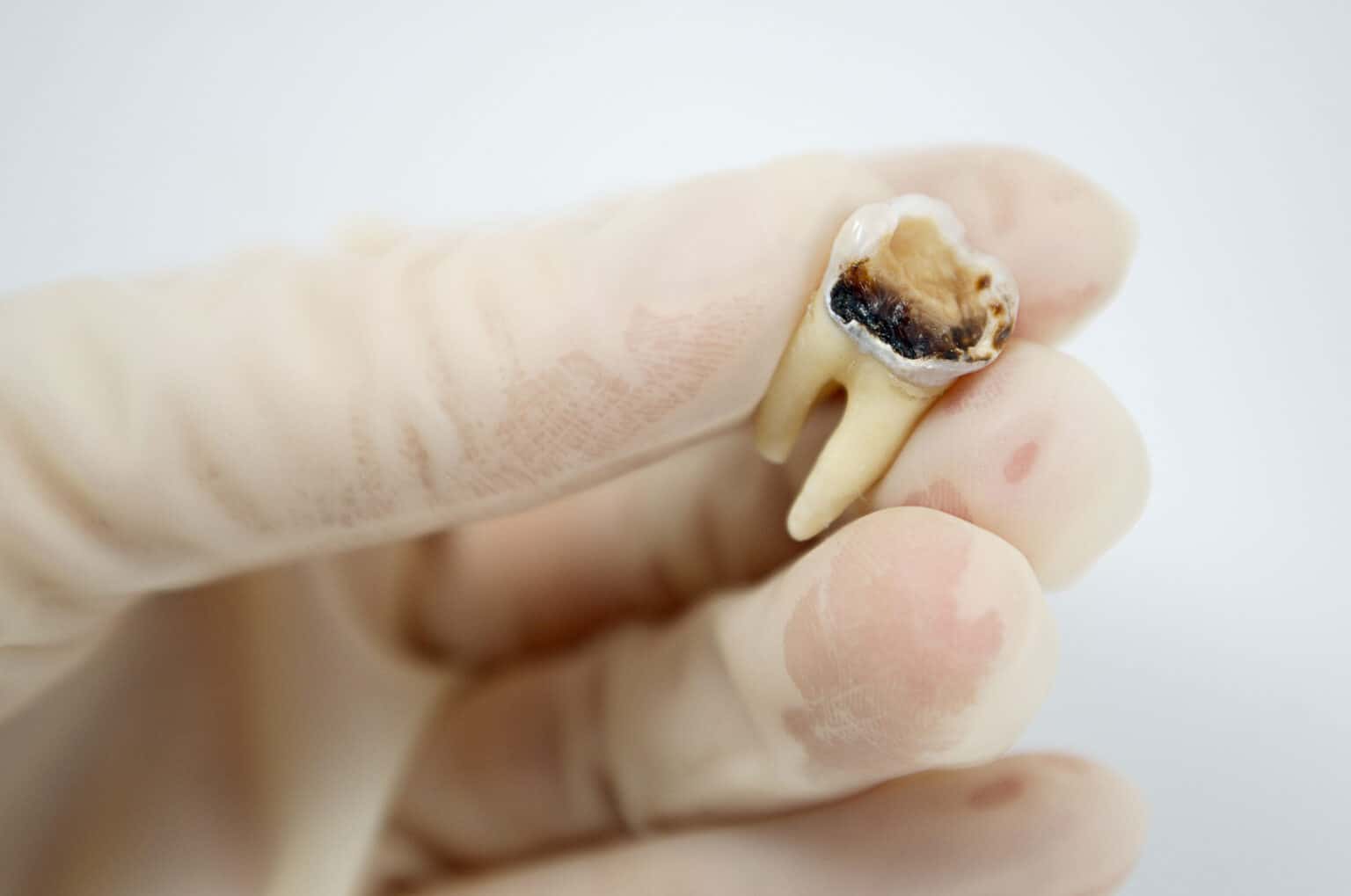 What is a Dead Tooth? Symptoms, Causes & Treatments